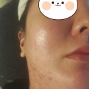 발생 원인 치료 후기 재발방지 화장품 헤라에스테틱(강남헤라에스테틱,염증성여드름,피부주사염,지루성...