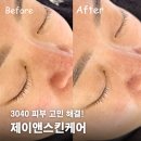 제이퍼포먼스 | 3040 피부 고민 해결! 원주 피부관리의 문제성 제이앤스킨케어 개선 후기