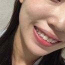 벨치과의원 | 강남 신사역 치아미백 레브치과 내돈내산 솔직후기