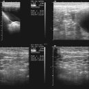 mesenteric lymphadenitis 이미지