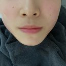 무선하나의원 | 강남피부과 셀리데이의원에서 요즘 핫한 온다리프팅 받고 온 후기!