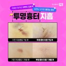 팔뚝 지방흡입 흉터 레이저 효과는 글쎄