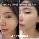 (주)실보이엔지 | 압구정역피부과 실리프팅 민트실 엔픽스실 6줄 추천 후기 4주차