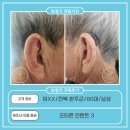 굿모닝보청기(경북대병원점) | 완주보청기,이XX 고객님 오티콘 인텐트 3 구매후기(80대,男)