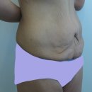 비만 치료후 남겨진 흔적 - 처진살 제거를 위한 바디컨투어링 수술 이미지