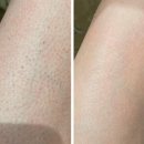 닭살이야 | 모공각화증 닭살피부 고통받았던 1人의 솔직 후기