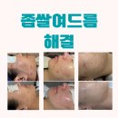 지긋지긋한 좁쌀여드름해결-서울대입구피부관리 -다드림피부연구소 (임상사진+후기)