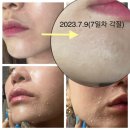 엘림약국 | 인셀덤 퍼스트패키지 사용방법 및 후기