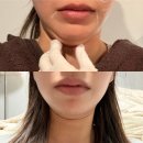 타임피부과의원 | 압구정역피부과, 쿨소닉 통증 붓기 다운타임 전후비교 아르나의원 후기