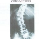 척추 측만증 판독 과 경추 1번 2번 이미지