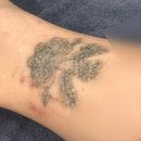 미뉴얼의원 | 문신제거 1회차 당일 후기