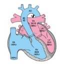 대혈관 전위 (Transposition Of Great Artery) 이미지