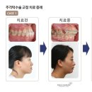 바른이치과의원 | 반포교정치과 웃는바른이 교정후기 사례