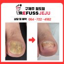 화인마트 | [제주무좀발톱]작업화 신다 생긴 엄지발톱고민 발톱스케일링 후기