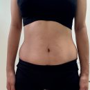 수원다이어트병원 잘하는곳, 경도비만 3주만에 탈출한 지방분해주사 하프컷 후기