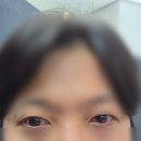 통영예일안과의원 | [스마일라식]강남스마일안과 내돈내산 스마일라식 후기 ✔️