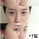 엘란쎄 필러 맞았어용!!!!!!:) 이미지