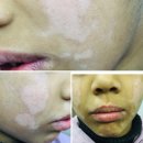 아이 백반증 의심 증상으로 병원 방문, 백색비강진 진단 후기(병원추천)