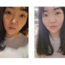 강남비비의원 | 강남역 서울비비의원 브이라인 보톡스 뉴럭스 일주일 차 후기