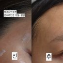 이영란헤어라인 | 주사피부염 가려움 크림 지루샵 세라마이드 후기 안면홍조 전후차이