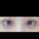 멍포유 | 필러 및 입꼬리 보톡스 후 팔자 이마 목 주름 사각턱 눈 밑 애교 시술 멍 통증 비용 실제 후기 일지 기록