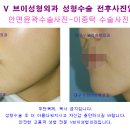 대구안면윤곽 주걱턱수술사진-장점,단점,부작용,회복법[대구성형외과,대구지방이식] 이미지
