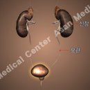 급성 방광염 (Acute cystitis) 이미지