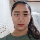 [내돈내산]홍대신촌점 톡X앤X 보톡스(원더톡스) + 여드름 관리 후기 (feat 여신티켓 어플 추천)