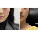 트리플리 | 대구 세르프 리프팅 600샷 내돈내산 솔직 후기 (+경과사진)
