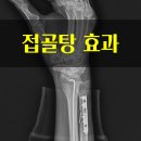 쾌차한의원 | 접골탕 효능, 치료 후기와 골절 회복 골진 증가 연구 결과