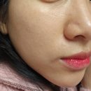 주식회사파마폰티스 | 클라디에 셀업 루비> 물광피부 신상 스킨부스터 시술7일차 / 후기, 효과, 유지기간, 통증, 가격, 부작용,