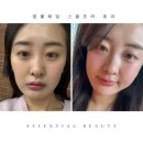 땅콩형 얼굴 필러 대신 스컬트라 볼패임 개선 내돈내산 후기