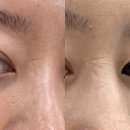강남 새살침 흉터 한의원, 미간 패인흉터치료 후기
