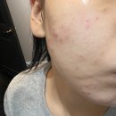 강남여드름압출 보름달뷰티 관리후기