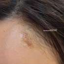 구림약국 | [경험] 봉고데기 하다 이마에 화상입음ㅠㅠ 응급처치, 경과 관찰 후 완치까지... / 얼굴화상 후기 연고추천