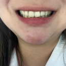 이건치과기공소 | 인생 첫 무삭제 라미네이트 (블랙필름 리얼 후기)