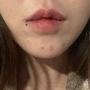 나을한의원 | 대구 범어동피부과 홍조 턱 여드름 치료 100%효과본 스킨부스터 내돈내산 후기