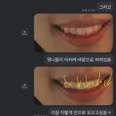 수원 인계동 교정치과 화이트바른이치과 상담후기(feat.치아교정 4번 하는 사람 보신 분)