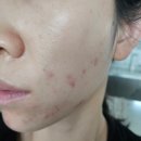 성인 여드름 레이저 아그네스 2주차 후기