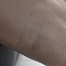 살그래 | 살리턴 착색크림 후기: 겨드랑이 팔꿈치 색소침착 꾸준히 발라봤습니다
