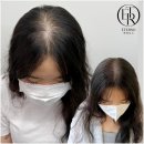 자연마주 | 부산두피문신 에테르노 SMP, 가르마, 정수리 자연스럽게 보완한 후기