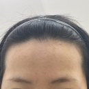 꿈을 심는 회사 | [1탄] M자 헤어라인 모발이식 비절개 2400모 내돈내산 상담,예약,당일 솔직 후기