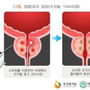 이식형 결찰사를 이용한 전립선 결찰 관련 질의응답 이미지