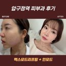 강한속내과유외과의원 | 압구정성형외과 맥스모드리프팅 인모드 후기, 얼굴주름리프팅 효과