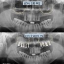연세행복을심는치과의원 | [아산 연세원치과]임플란트 심을 뼈가 얇을 때, '상악동 거상술' 전 꼭 확인해야 할 3가지