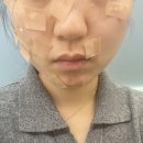 오천성모의원 | 약수역 리메이 피부과에 2,200원으로 점 뺀 후기 :: 다른 피부과 비교(노벨클리닉, 맑은성모피부과)