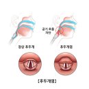 후두개염(Epiglottitis) 이미지