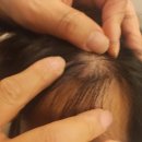 박외과의원 | 내돈내산) 남자 모발이식 재수술 1달차 후기/ 1회차때 비어있던 부분을 다시 살리다..! 모발이식 재수술...