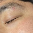 춘천터미널근처, 문제성 여드름 제대로 관리받은 후기 (더나은뷰티)