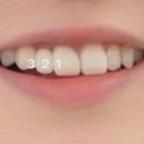 [치과후기] 대구 성서 이곡동 신세계치과 | 치아 앞니 브릿지 지르코니아 후기/가격